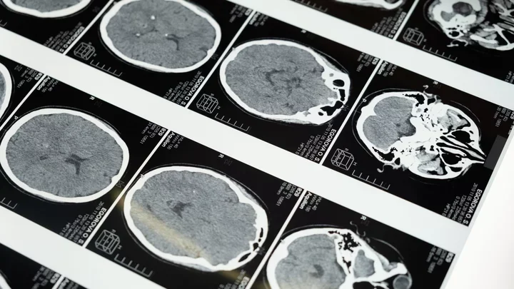 Imaging of the brain.